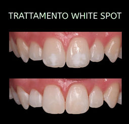 TRATTAMENTO DELLE MACCHIE BIANCHE (WHITE SPOT)